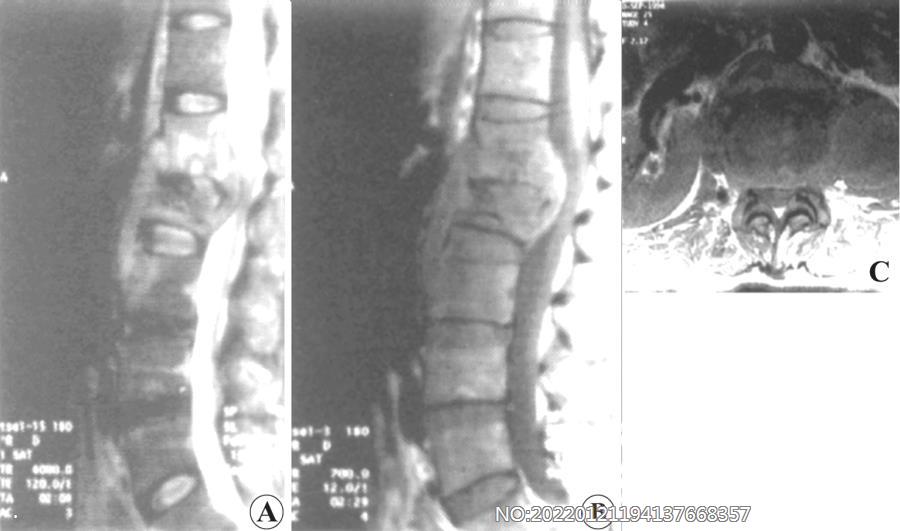 图8-129腰1-2椎体结核MRI表现.jpg