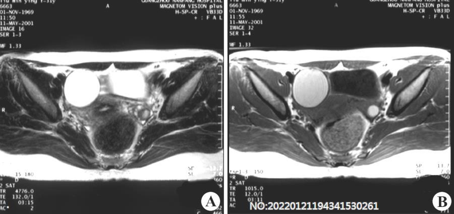 图7-40右侧附件区巧克力囊肿MRI.jpg