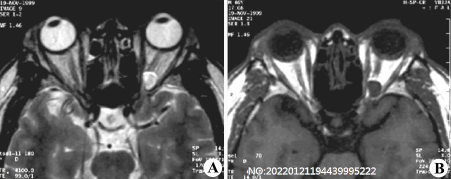图2-9左侧眶内炎性假瘤.jpg