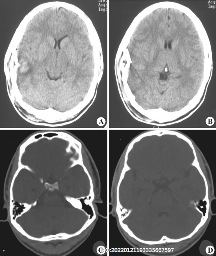 图2-39右颞骨骨折并颞叶脑挫裂伤.jpg
