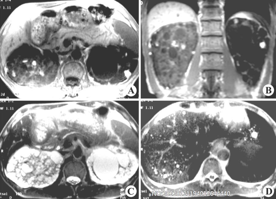 图6-157多囊肾MRI.jpg