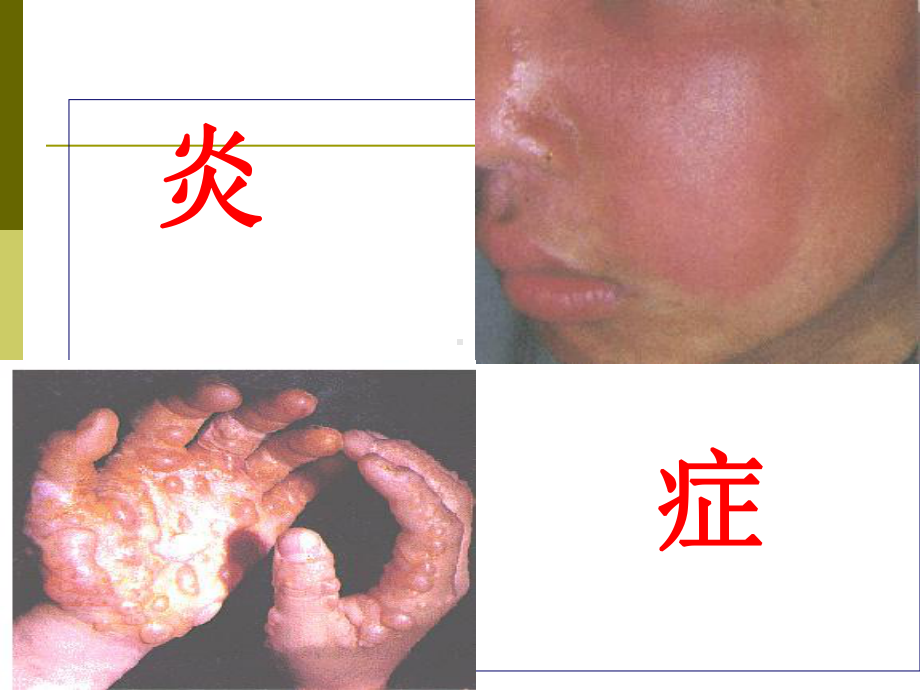 病理学课件：2017本科3-炎症分类,结局、意义.ppt_第1页