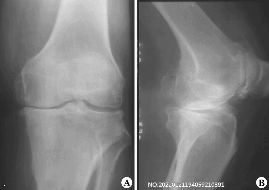 图8-43关节退行性变X线表现.jpg