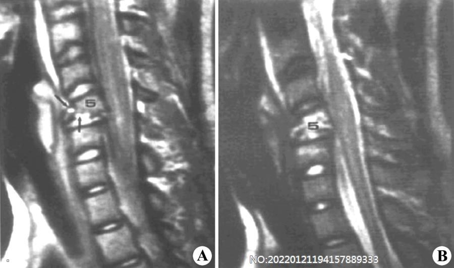 图8-72颈5椎体骨折MRI表现.jpg