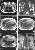 图6-136左肾错构瘤MRI.jpg