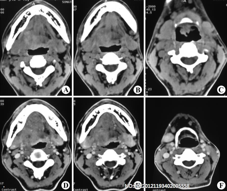 图2-89舌癌并颈淋巴结转移CT.jpg