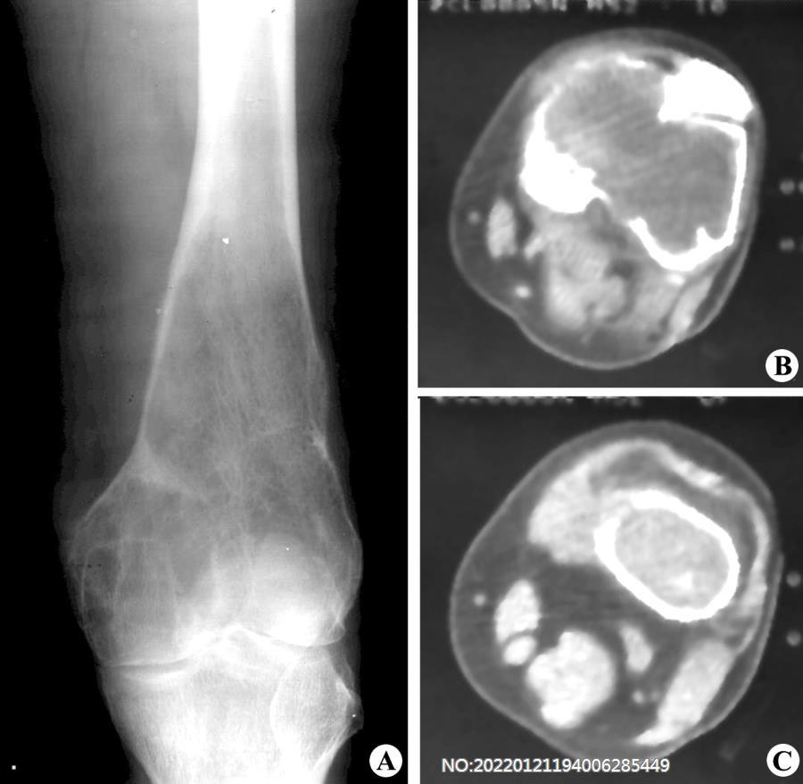 图8-204骨巨细胞瘤X线及CT表现.jpg