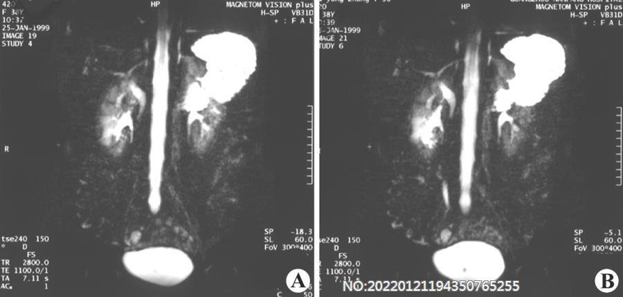 图6-26右双肾盂、肾盏、输尿管畸形MRU.jpg