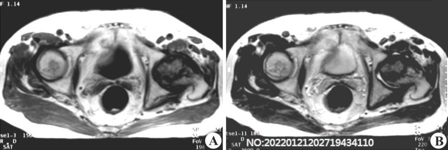 图8-36骨质坏死MRI表现.jpg