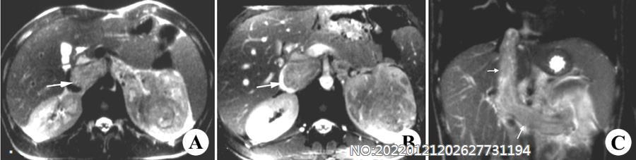 图6-110左肾癌伴肾静脉、下腔静脉内瘤栓MRI.jpg