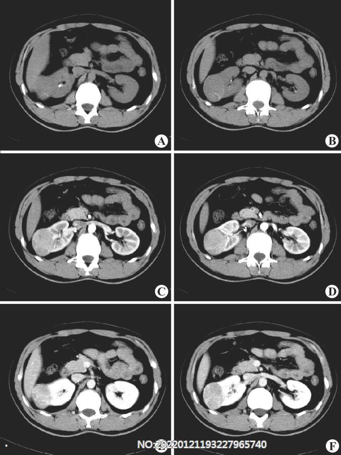 图6-109右肾癌CT.jpg
