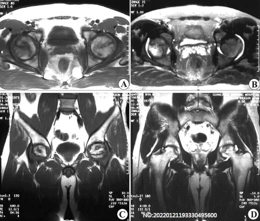 图8-180股骨头缺血性坏死MRI表现.jpg