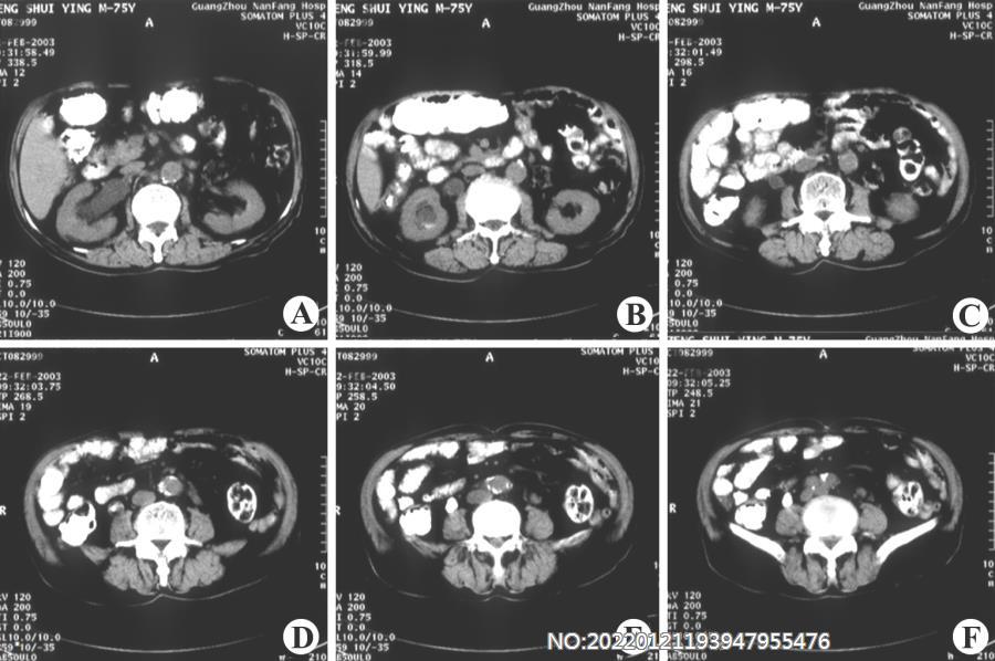 图6-70右输尿管结石CT.jpg