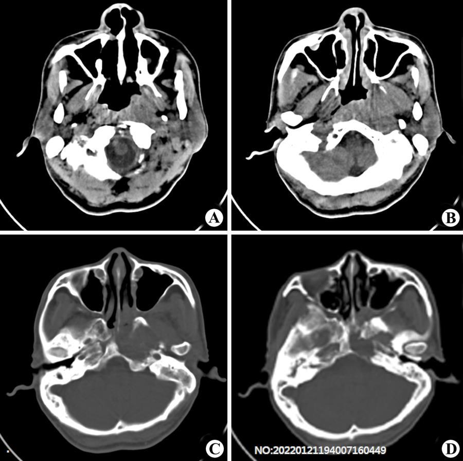 图2-68鼻咽癌并颅底骨质破坏.jpg