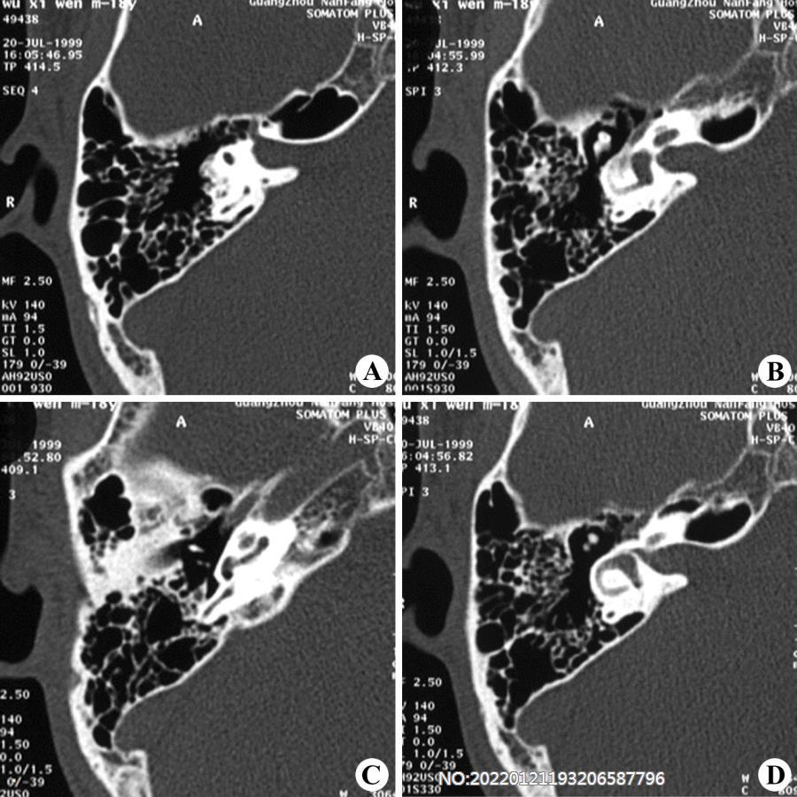 图2-27正常颞骨高分辨率CT横断（A-D）.jpg