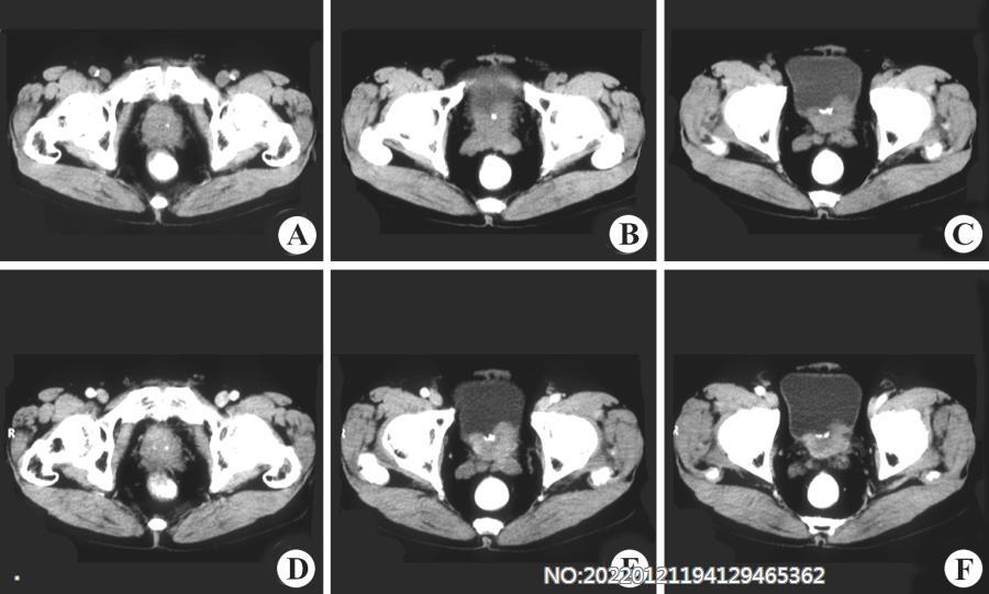 图7-61前列腺低分化腺癌CT.jpg