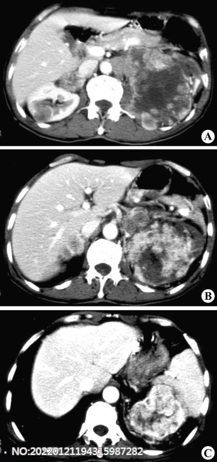 图6-108左肾癌伴右肾上腺转移CT.jpg