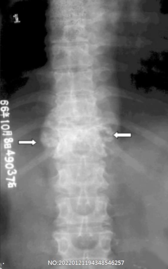 图8-123胸11-12椎体结核伴椎旁脓肿.jpg