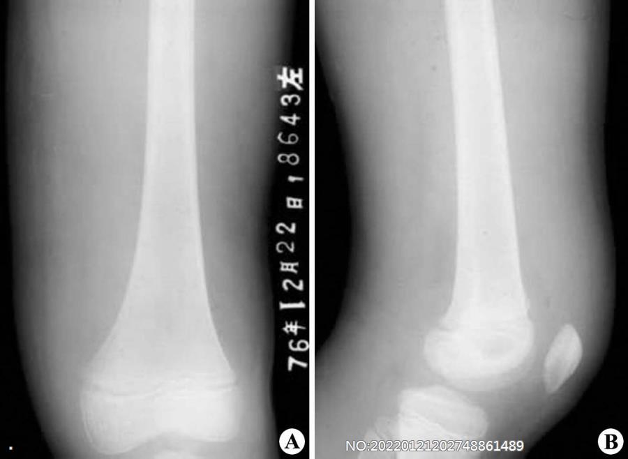 图8-102左侧股骨下段早期急性化脓性骨髓炎.jpg