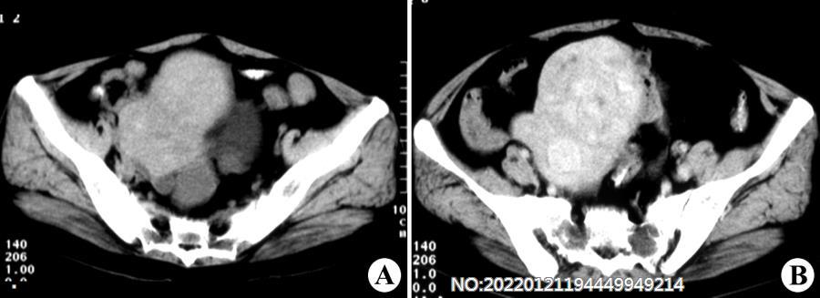 图7-22子宫体肌瘤CT.jpg