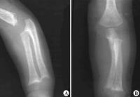 图8-175肾小管性骨病X线表现-抗维生素D佝偻病.jpg