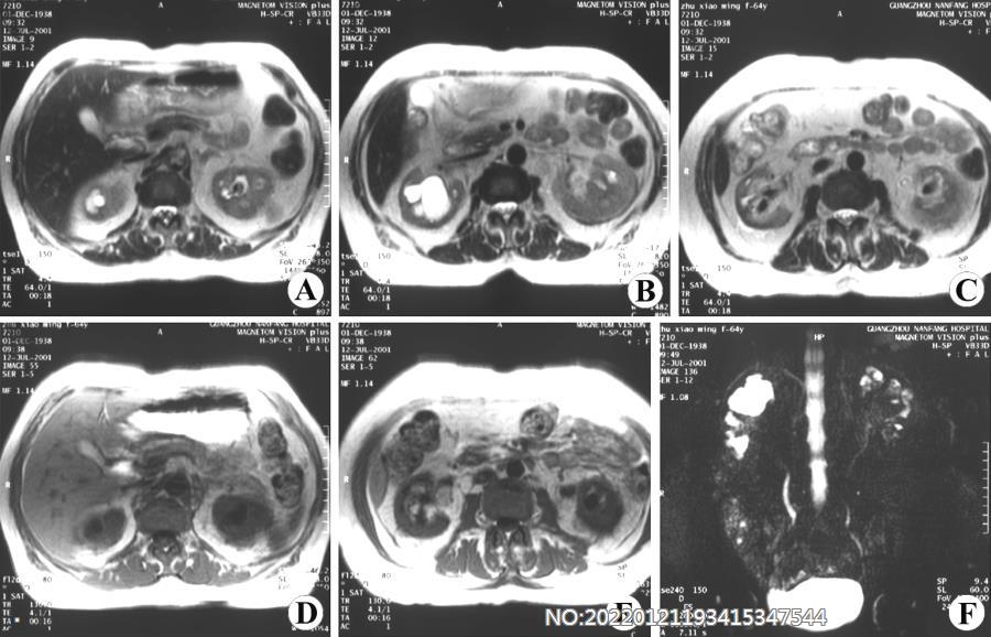 图6-60双肾结石MRI.jpg