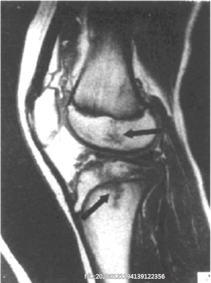图8-79骨骺挫伤 MRI表现.jpg