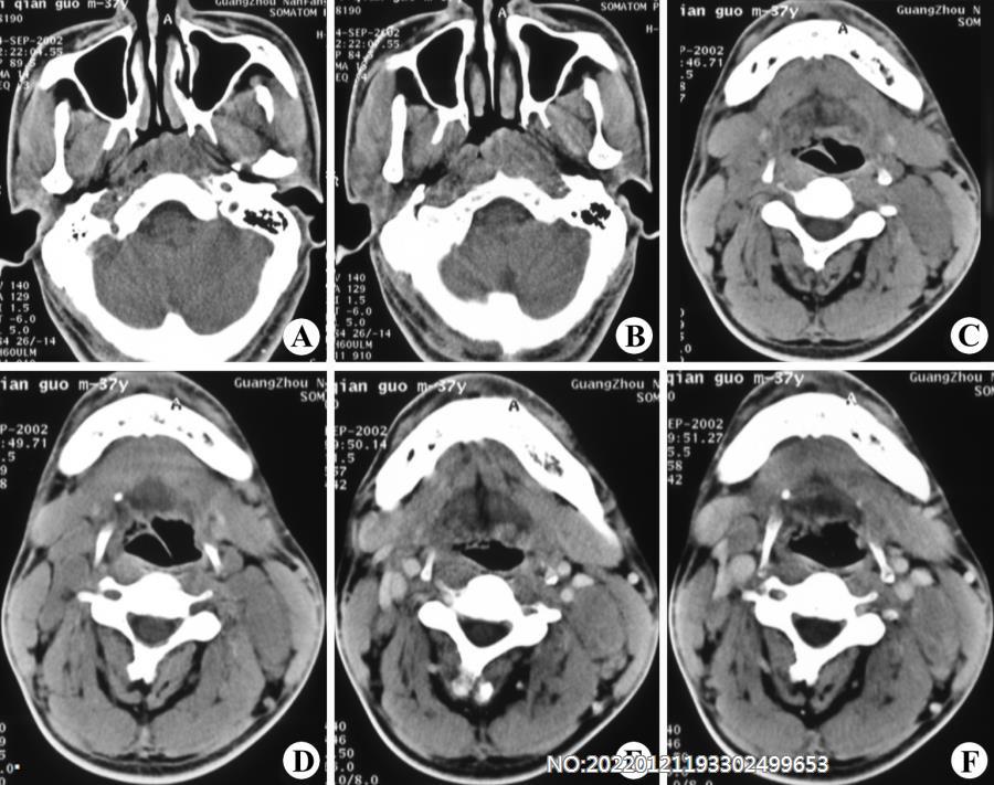 图2-69鼻咽癌并颈部淋巴结转移.jpg
