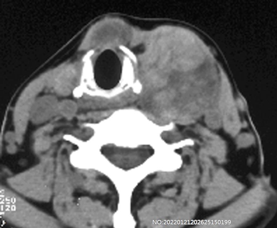 图2-105左侧甲状腺瘤.jpg
