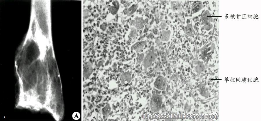 图8-197骨巨细胞瘤标本X线片及组织学切片.jpg