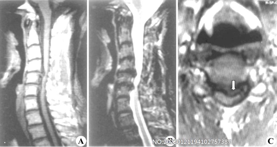 图8-95颈间盘突出MRI表现.jpg