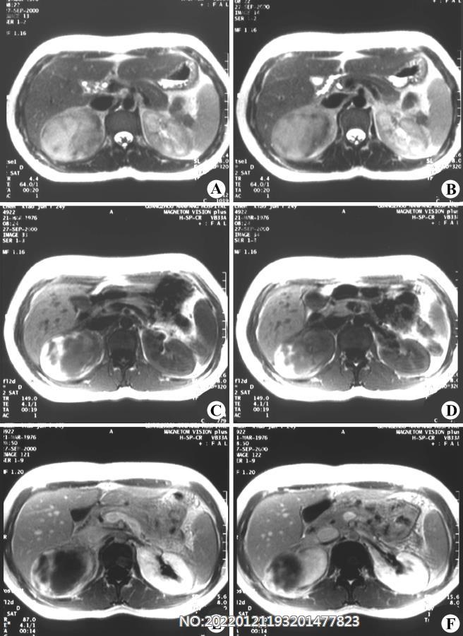 图6-176右肾上极囊肿并出血MRI（手术证实）.jpg