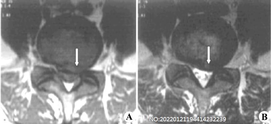 图8-96腰间盘突出MRI表现.jpg