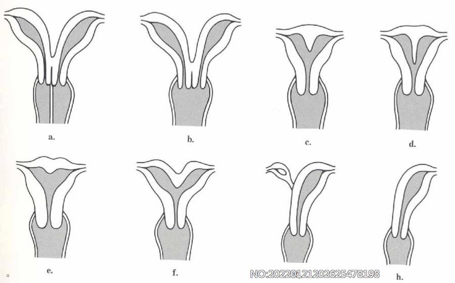 图7-15各种子宫先天异常示意图.jpg