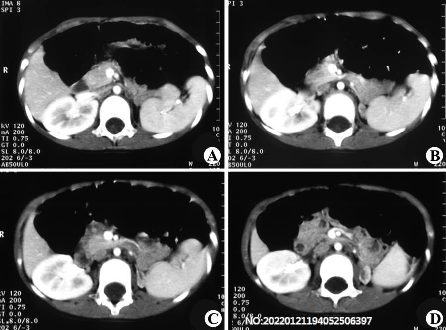 图6-47左肾发育不良CT.jpg