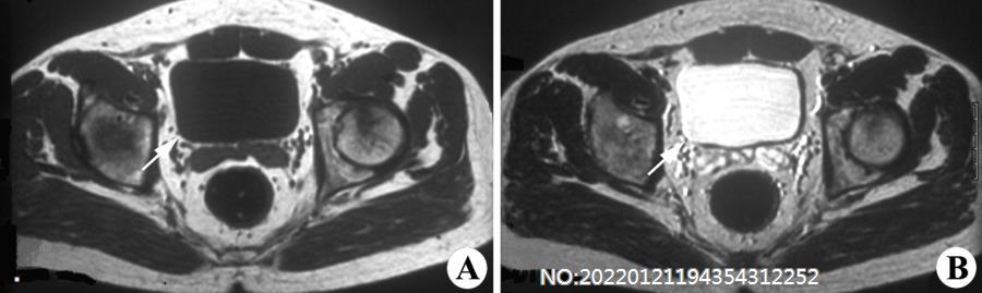 图6-16正常膀胱MRI（男性盆腔横断面）.jpg