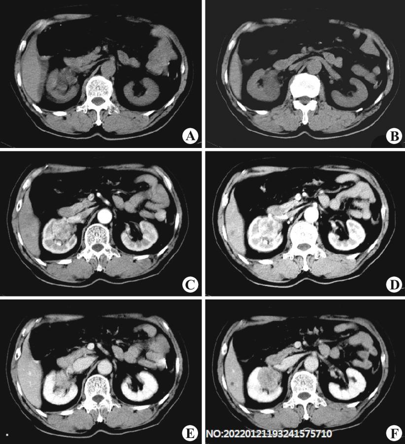 图6-129右肾盂癌CT.jpg