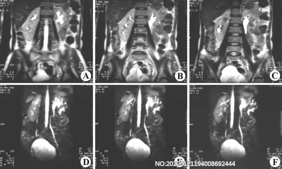 图6-27右肾盂、肾盏、输尿管畸形MRI.jpg