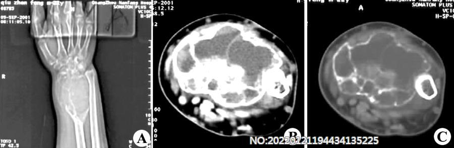 图8-205骨巨细胞瘤X线及CT表现.jpg