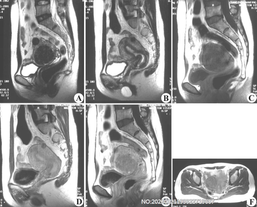 图7-24子宫壁间肌瘤MRI.jpg