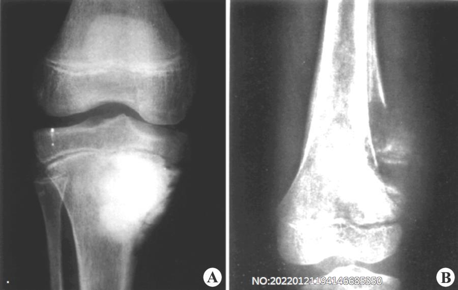 图8-211骨肉瘤基本X线表现.jpg