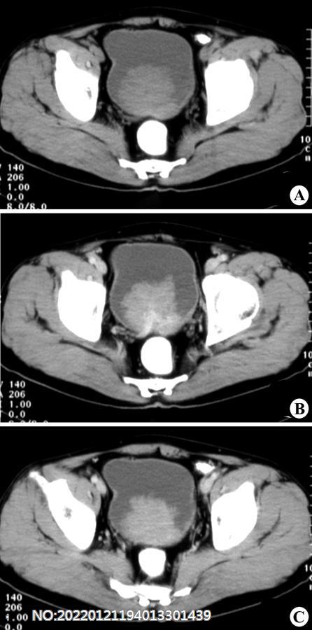 图6-144膀胱后壁癌CT.jpg
