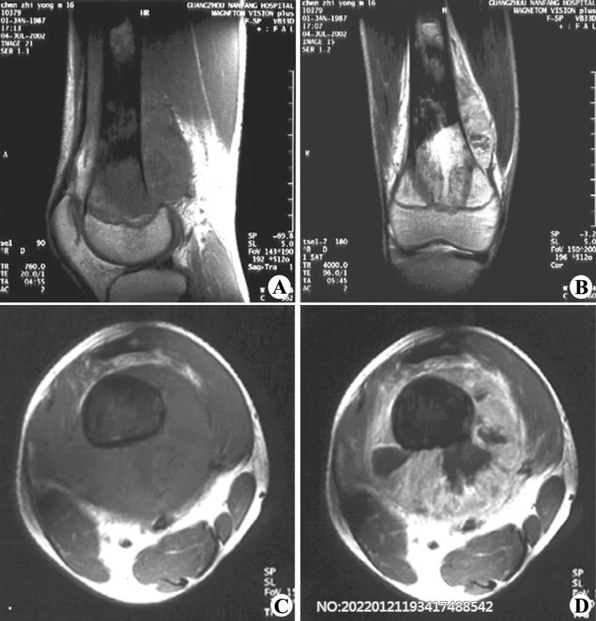 图8-218骨肉瘤MRI表现.jpg