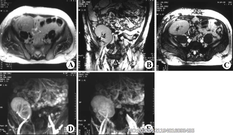 图6-185右髂窝移植肾MRI.jpg