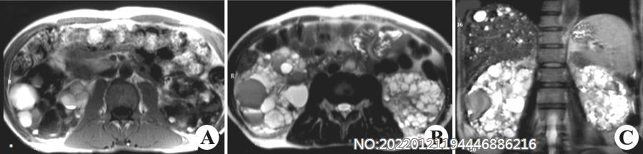 图6-158多囊肾MRI.jpg