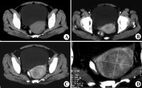 图7-23子宫肌瘤CT.jpg