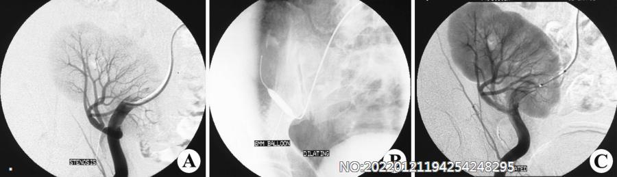 图6-188移植肾肾动脉狭窄球囊扩张术.jpg