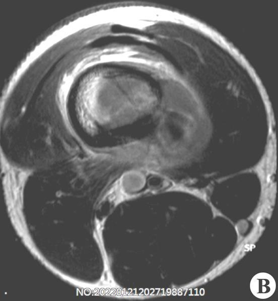 2-2骨膜增生MRI-T1（右股）.jpg