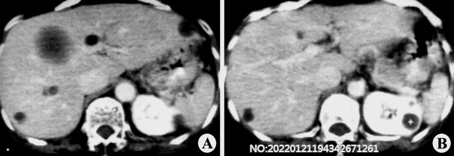 图6-159肾囊肿并肝囊肿CT.jpg