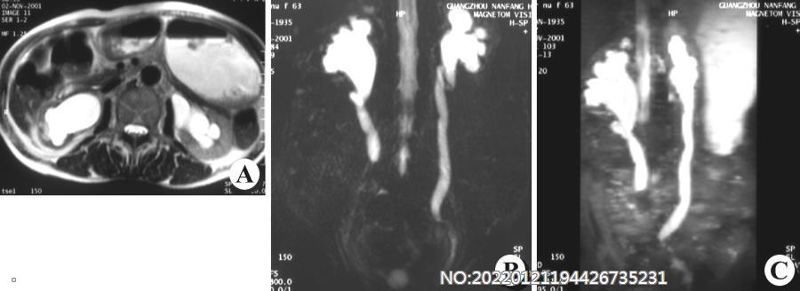 图6-20双肾及双输尿管积水MRU.jpg